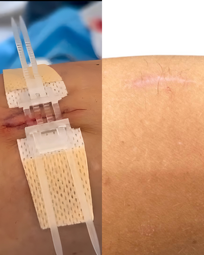 Advanced Wound Closure Kit: ZipClose Laceration (Stitch Free)