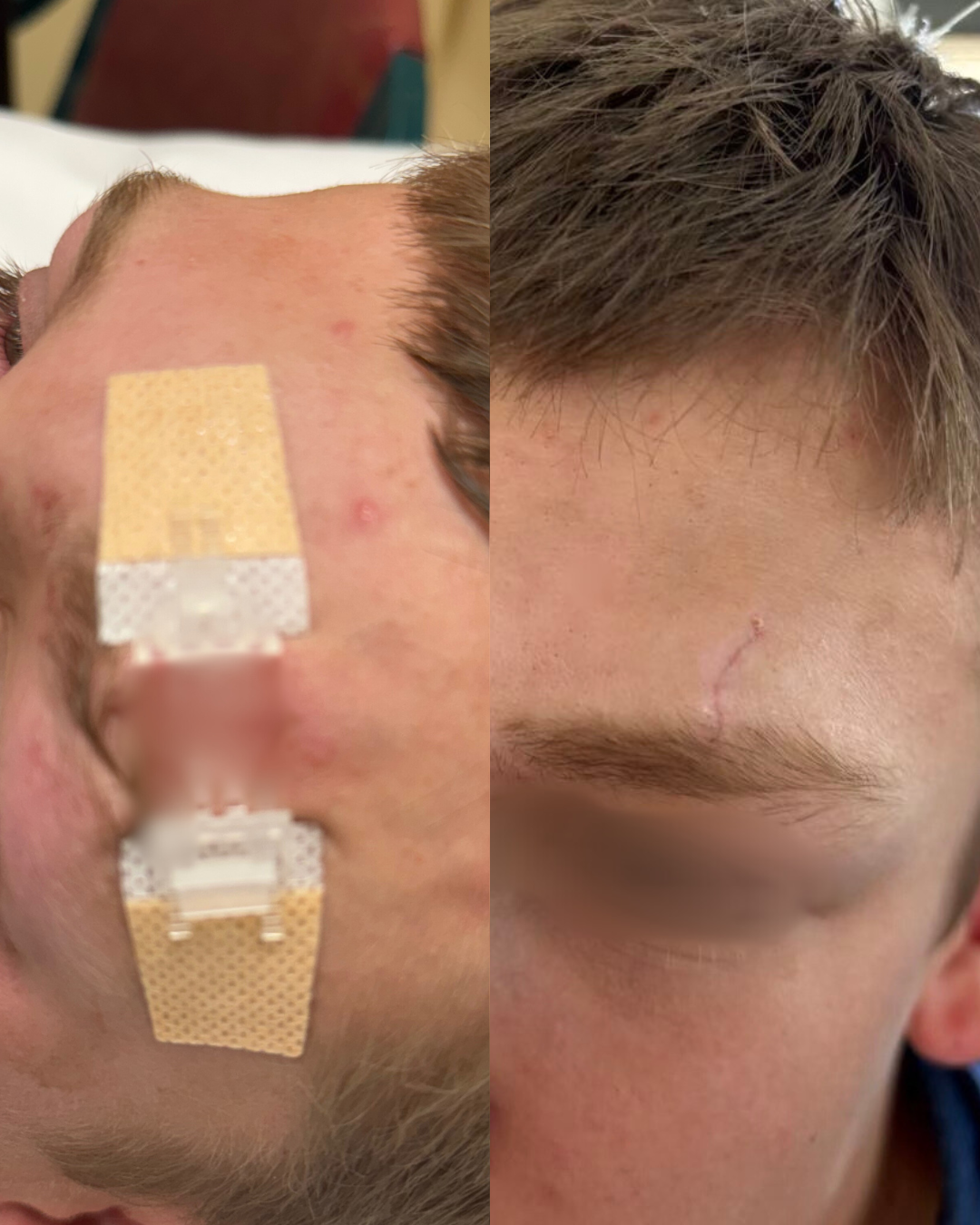 Advanced Wound Closure Kit: ZipClose Laceration (Stitch Free)